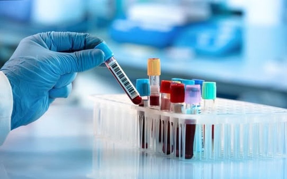 Tubos de exame de sangue em laboratório, usados na investigação hormonal da SOMP
